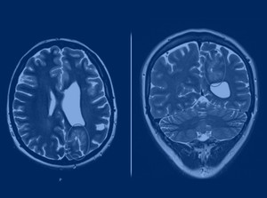 МРТ головного мозга при эпилепсии